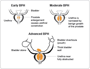 benign prostatic hyperplasia symptoms