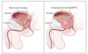 BPH Prostate