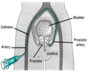  Embolisation of prostatic artery