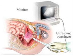 ultrasound prostate