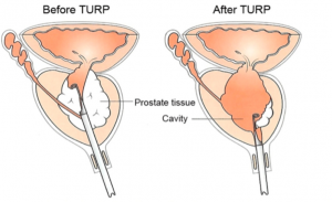 turp procedure