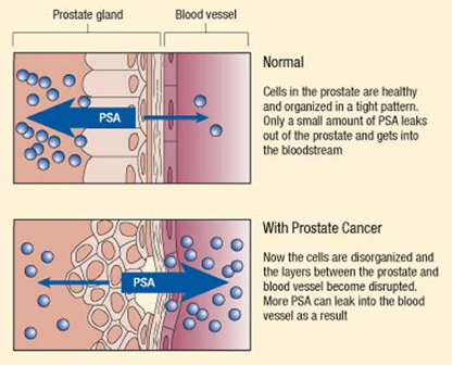 prostate cancer symptoms psa test)